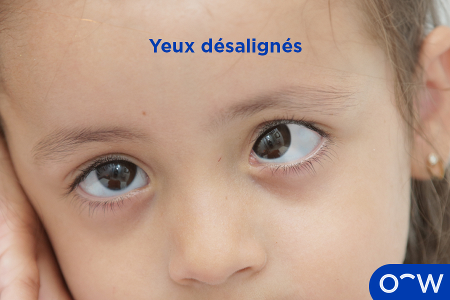 Gros plan des yeux désalignés d’un enfant avec son œil gauche tourné vers l’intérieur et son œil droit regardant tout droit.