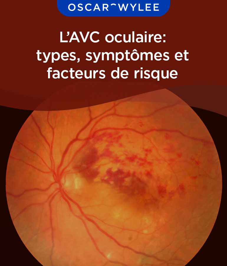 L’AVC oculaire: types, causes,symptômes et traitements