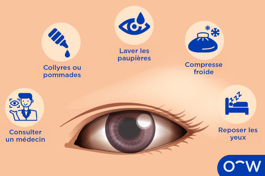 Infographique des traitements de l'irritation oculaire.