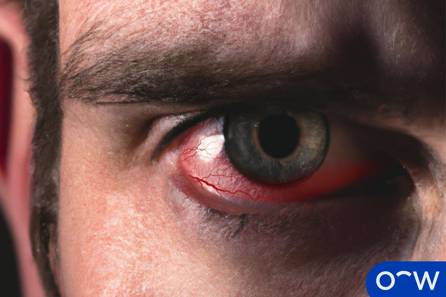 Gros plan sur l'œil d'un homme aux yeux rouges a cause d'une irritation oculaire.