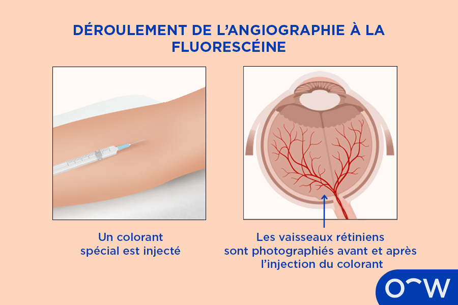 Une image montrant une injection insérée dans le bras et un globe oculaire avec ses veines