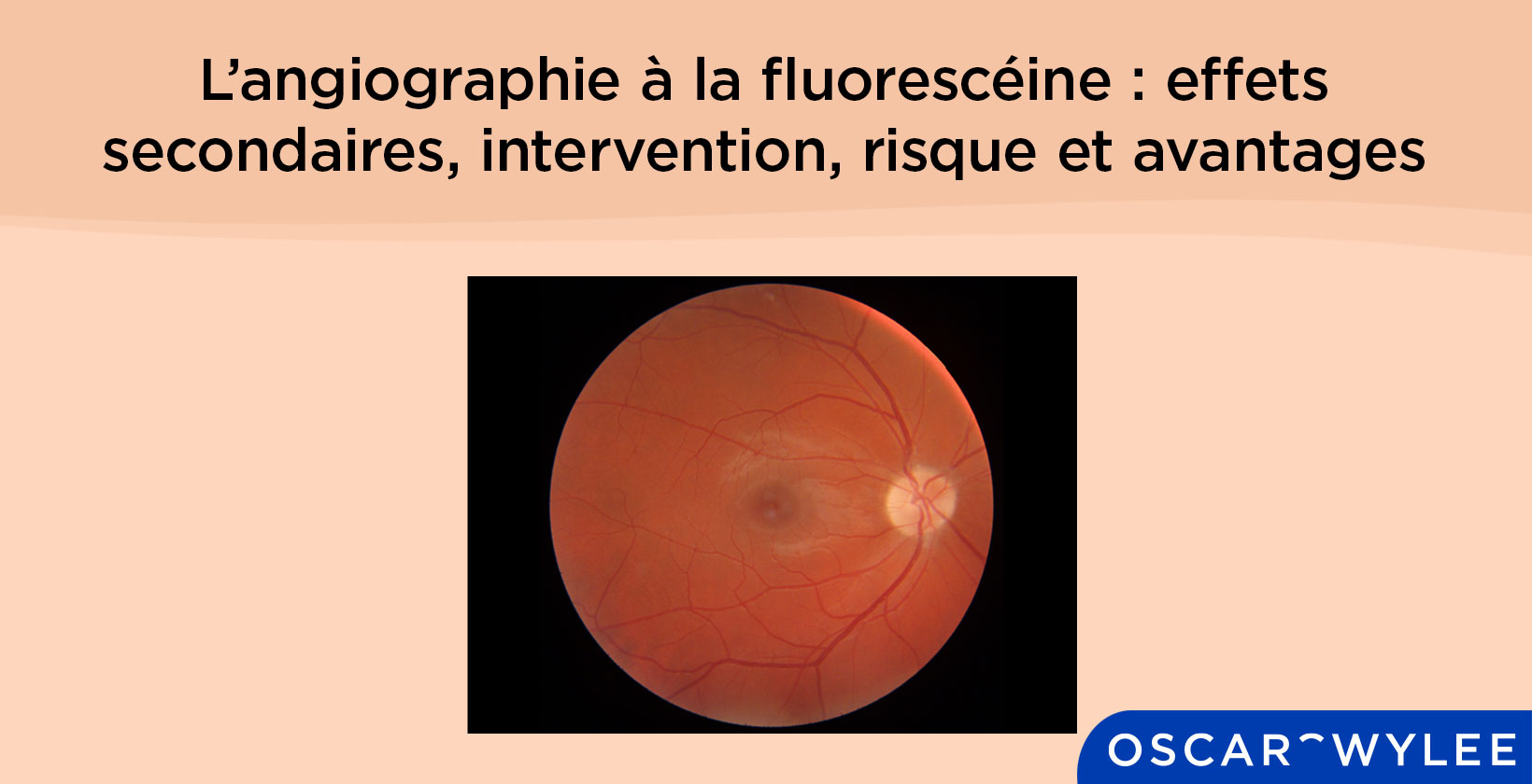 L’angiographie à la fluorescéine
