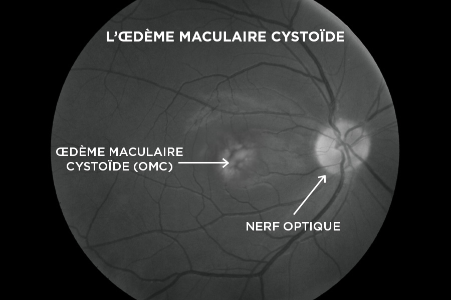 Résultats d’une angiographie à la fluorescéine indiquant des signes d’œdème maculaire cystoïde, une des nombreuses maladies oculaires qui peuvent être détectées.