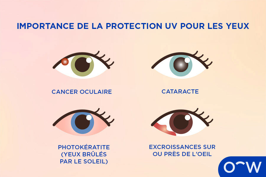 Infographique illustrant les différentes affections oculaires qui peuvent apparaître suite à l'exposition prolongée aux rayons UV du soleil.