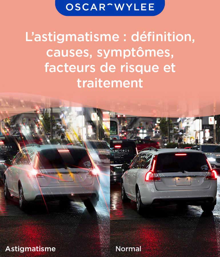 L’astigmatisme : causes, facteurs de risque et traitement