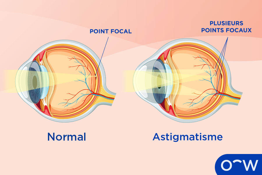 Definition of astigmatism