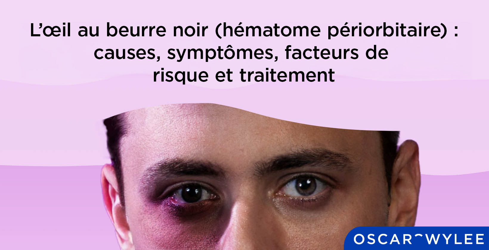 L’œil au beurre noir (hématome périorbitaire) causes, symptômes, facteurs de risque et traitement