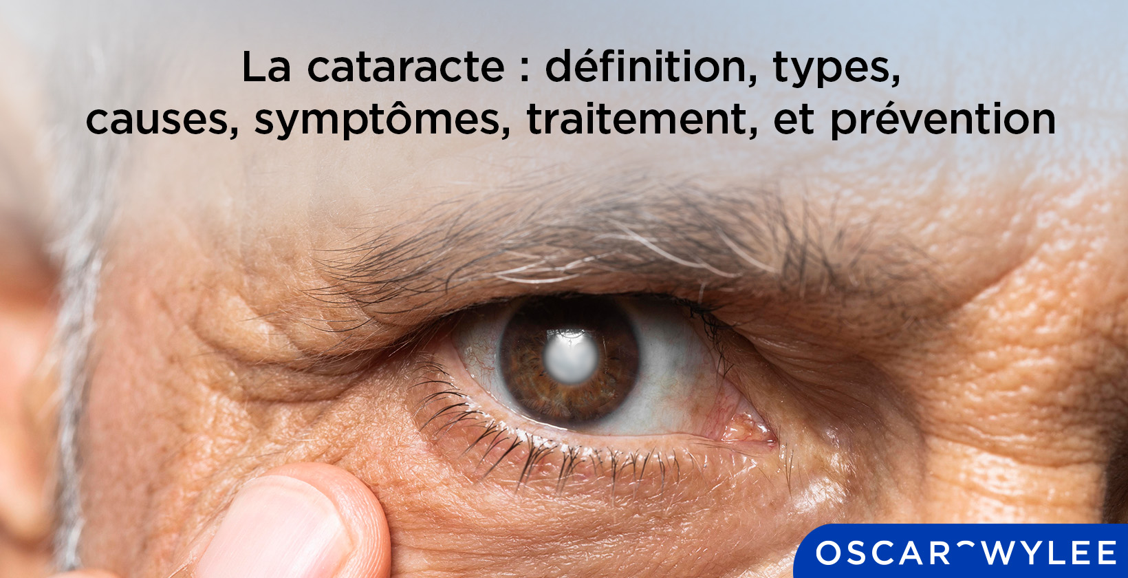 Inflammation des paupières (blépharite)