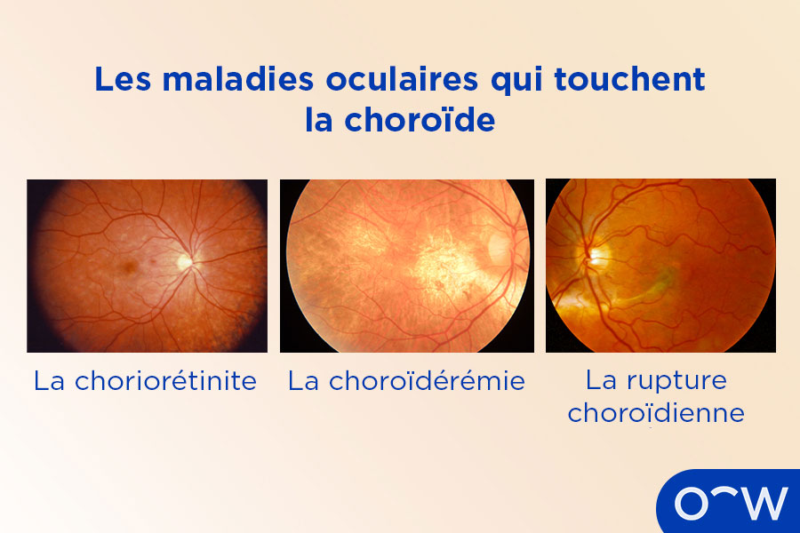 Trois globes oculaires, un souffrant de choriorétinite, un souffrant de choroïdérémie et un souffrant de rupture choroïdienne
