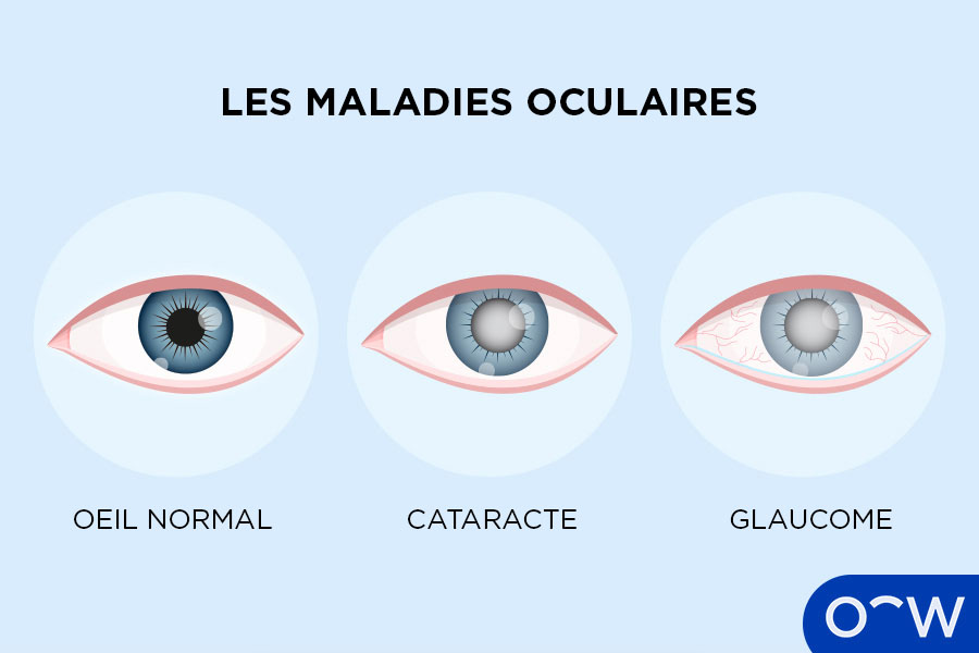 Infographique de certaines maladies oculaires variées
