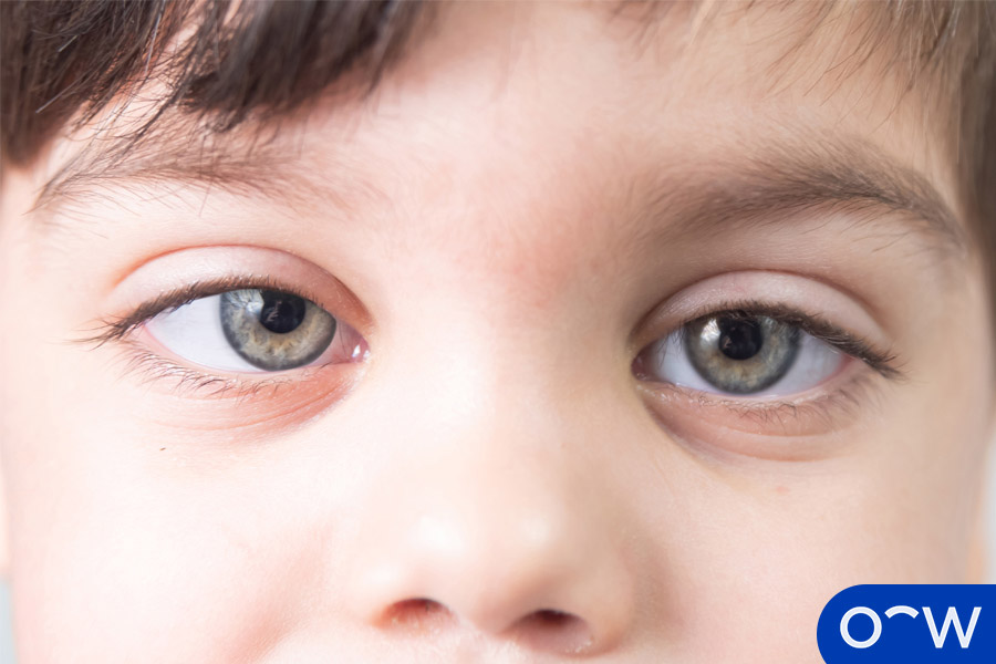 L’œil paresseux (amblyopie) : causes, symptômes, diagnostic et traitement