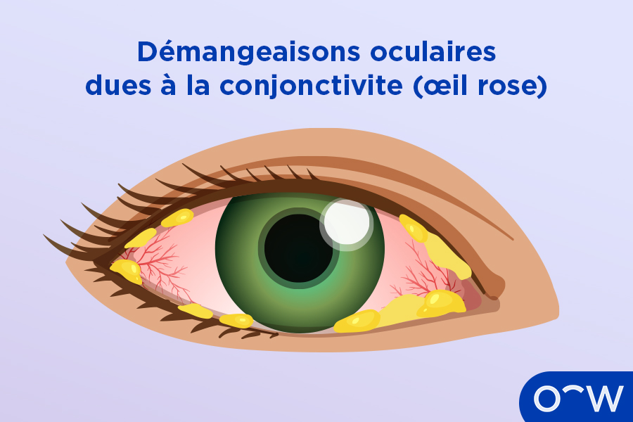 Des démangeaisons oculaires dues à une conjonctivite (œil rose)