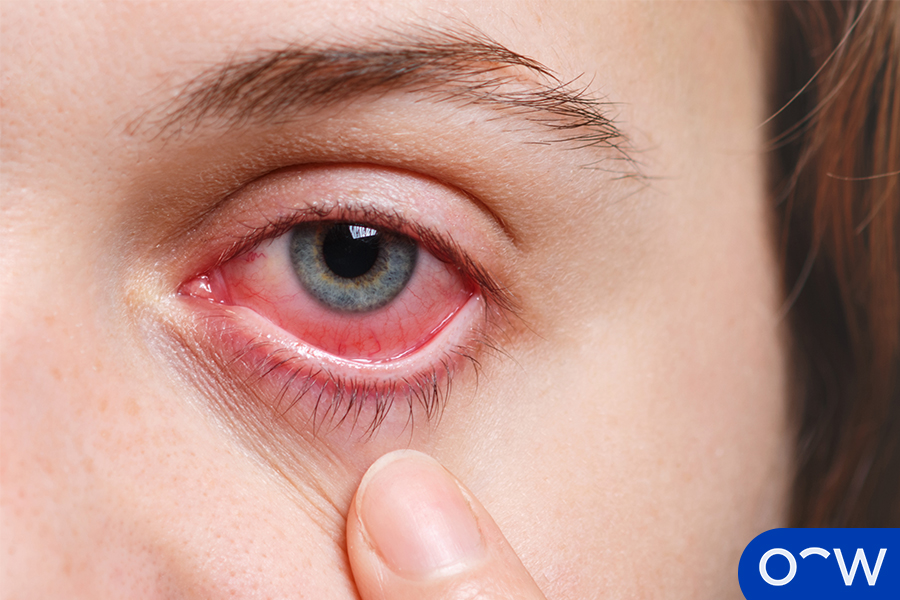 Illustration de la douleur oculaire.