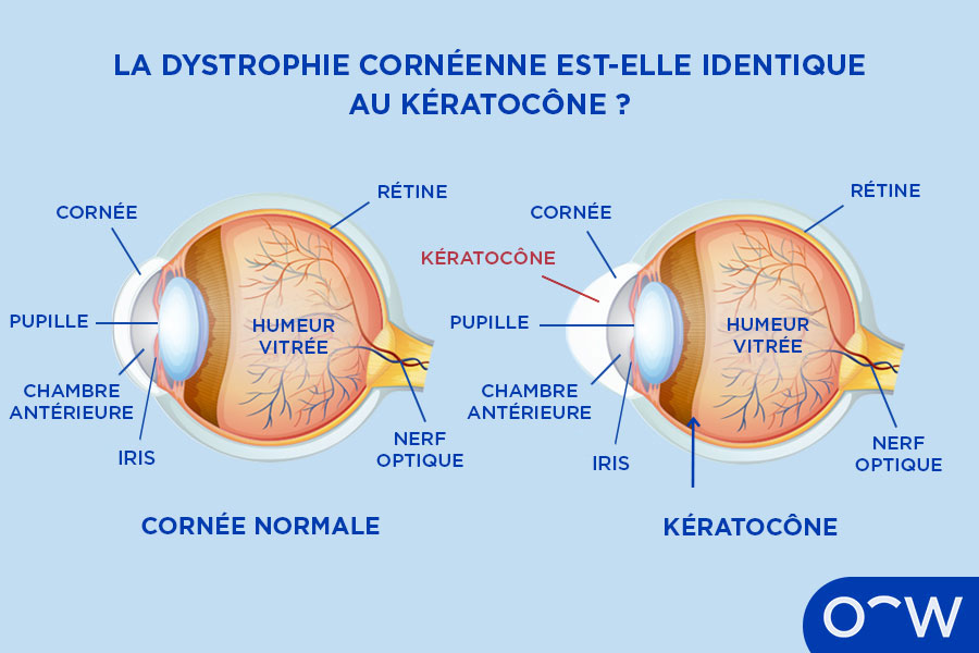 Schéma d’une cornée normale, à côté du schéma d’une cornée touchée par un kératocône.