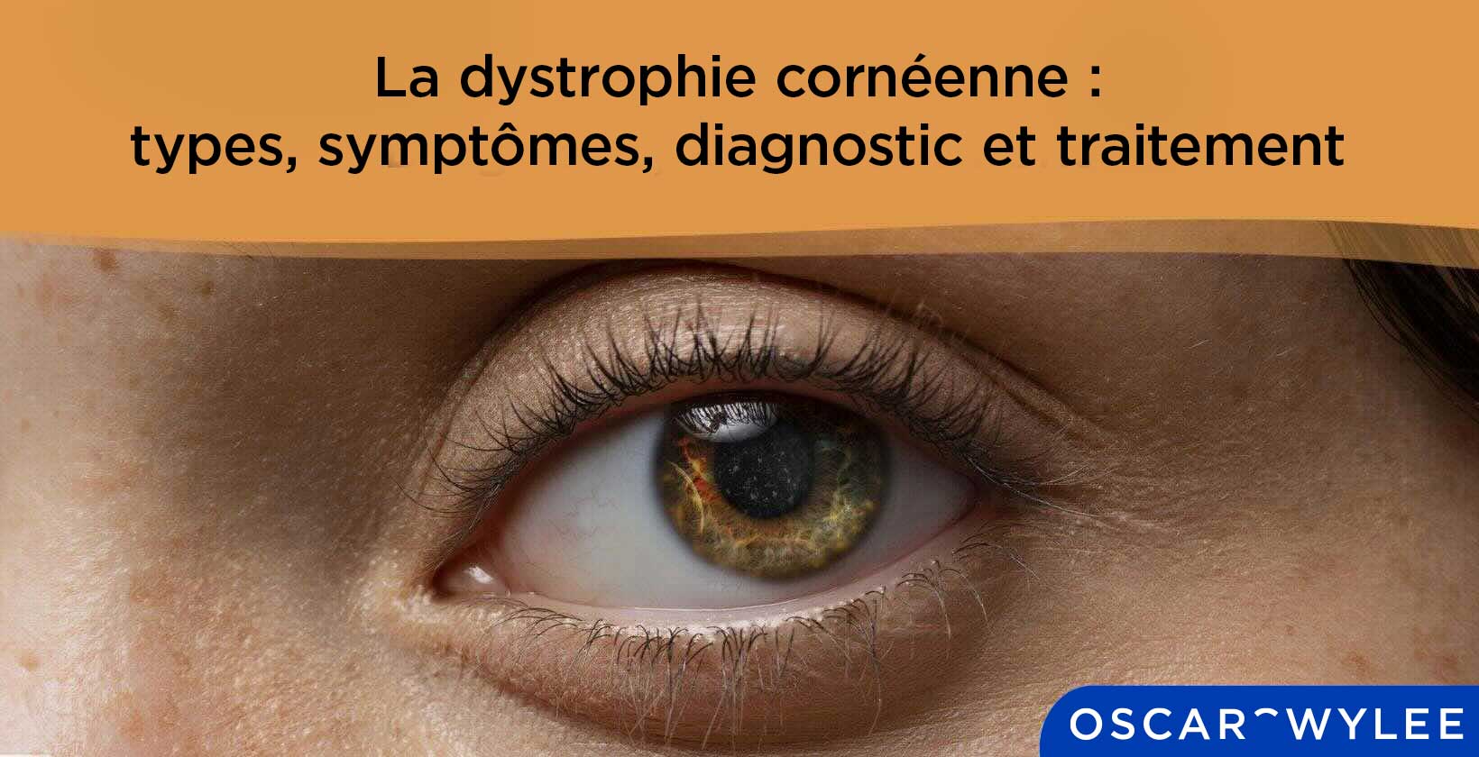 La dystrophie cornéenne