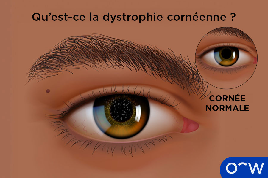 Gros plan d’une cornée touchée par une dystrophie cornéenne.