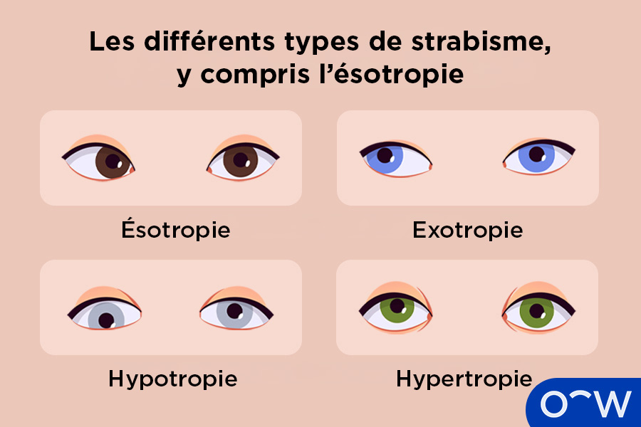Un exemple illustrant comment l'ésotropie diffère des autres types de strabisme