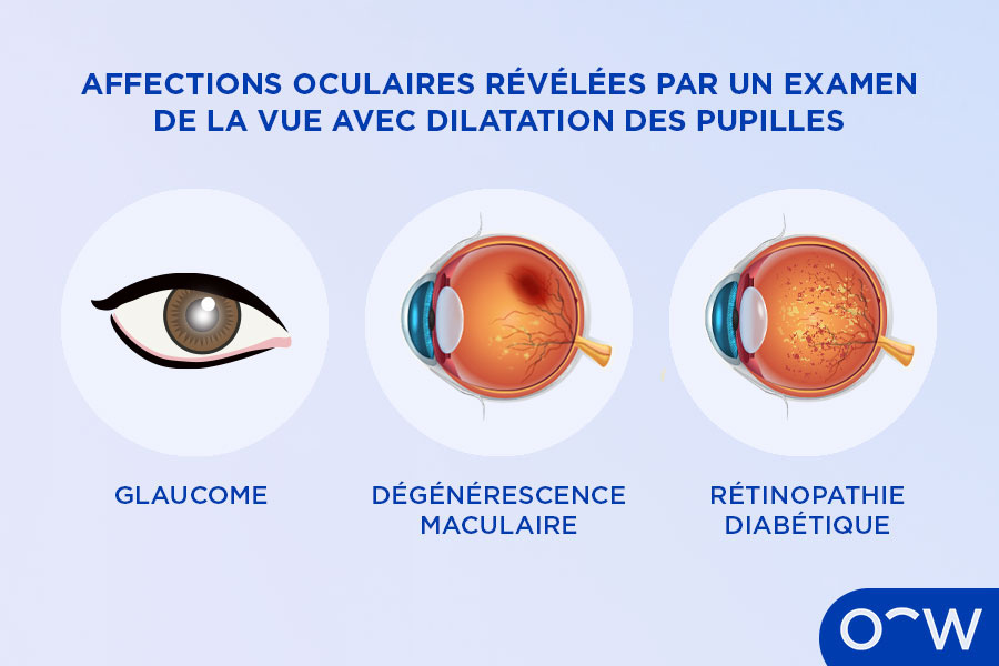 Les affections oculaires qu’on peut diagnostiquer à l’aide d’un examen de la vue avec dilatation des pupilles