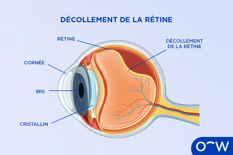 Schéma d'un décollement de la rétine, une des nombreuses affections oculaires qui peuvent être détectées grâce à un examen de la rétine.