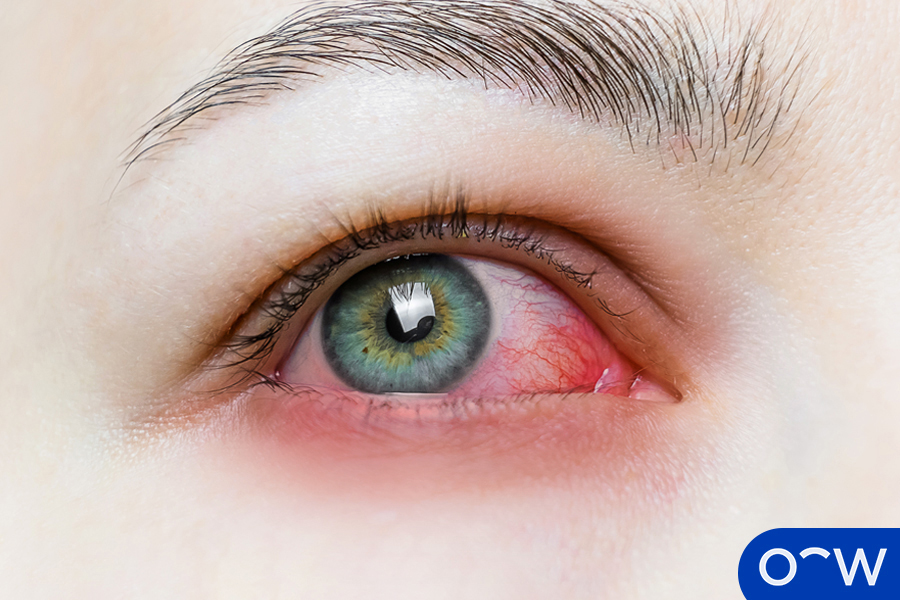 Une personne aux yeux douloureux