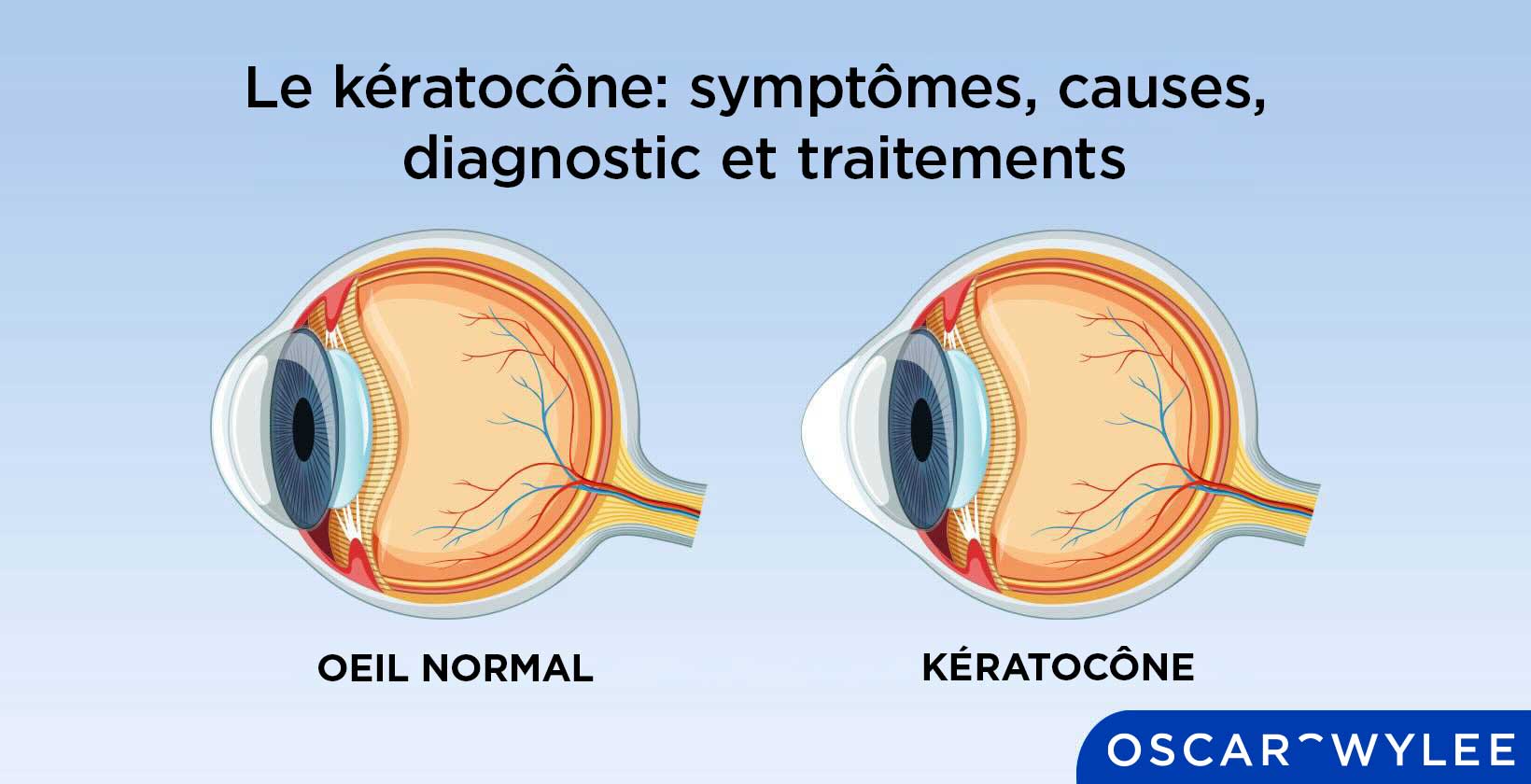Le kératocône.
