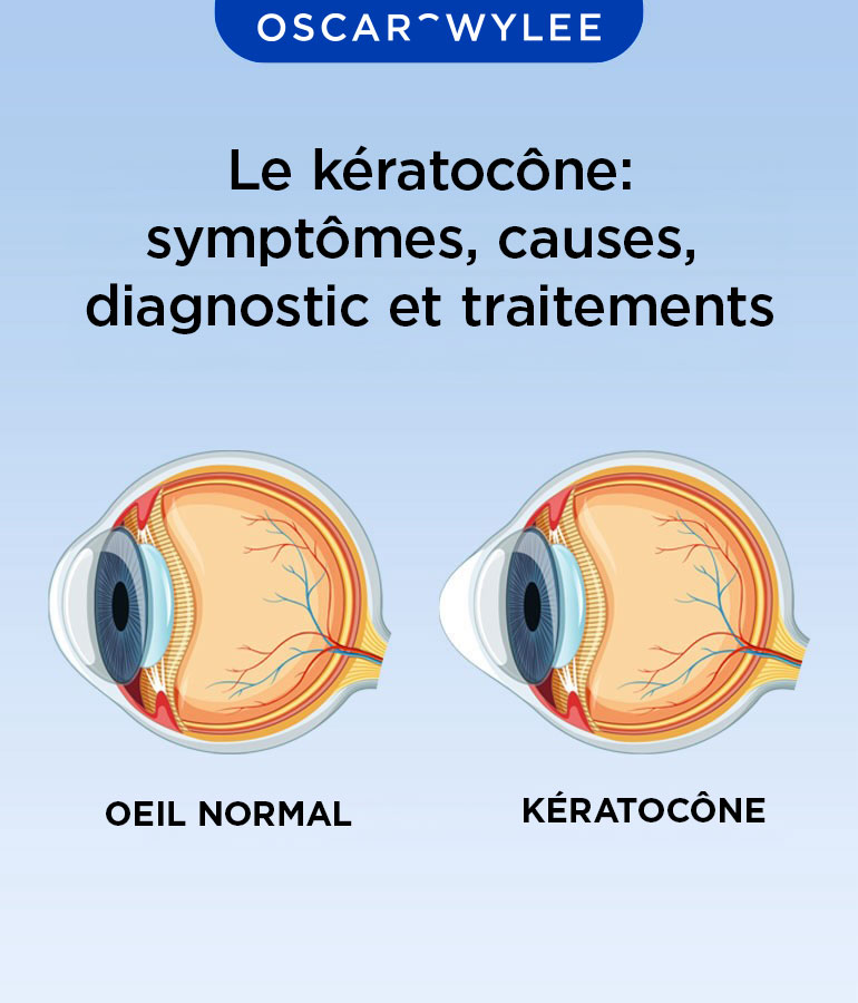 Le kératocône.