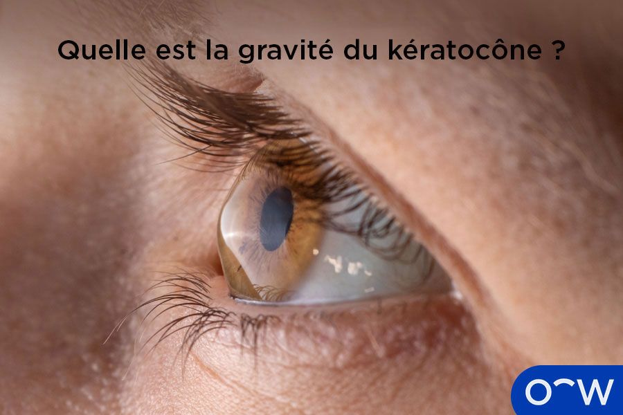 Gros plan d’un œil dont la vision a été atteinte par un kératocône, et ayant une cornée en forme de cône.