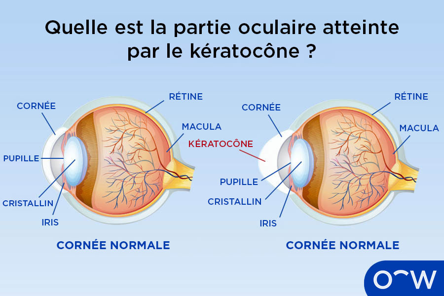 Une coupe transversale annotée d’un œil normal avec une cornée en forme de dôme, et une coupe transversale annotée d’un œil atteint de kératocône, avec une cornée en forme de cône.