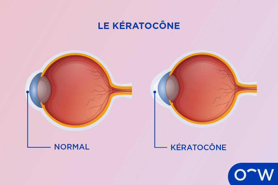 Schéma d’un type de maladie cornéennes, le kératocône, et son effet de renflement de la cornée.