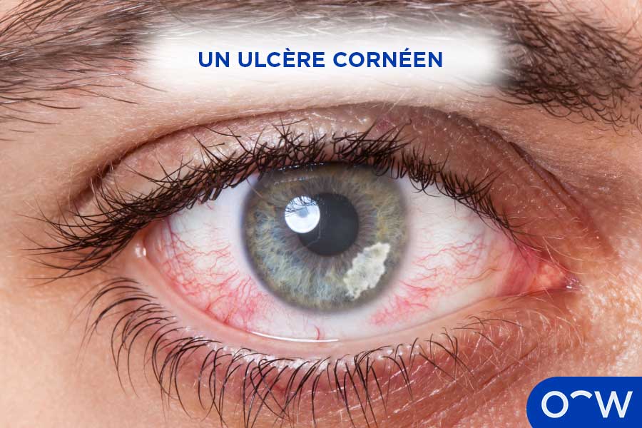 Une tache blanche grisâtre sur la cornée, appelée ulcère cornéen.