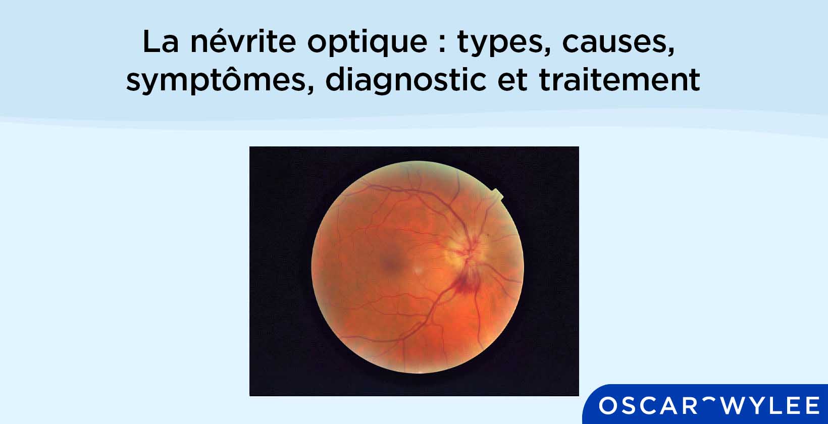 La névrite optique : types, causes, symptômes, diagnostic et traitement