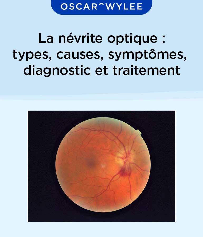 La névrite optique : types, causes, symptômes, diagnostic et traitement