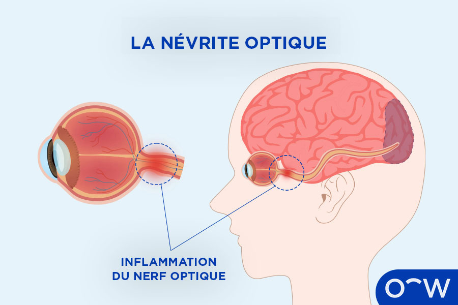 Un graphe illustrant l'intérieur de l'œil, révélant le nerf optique et sa connexion des yeux vers le cerveau.