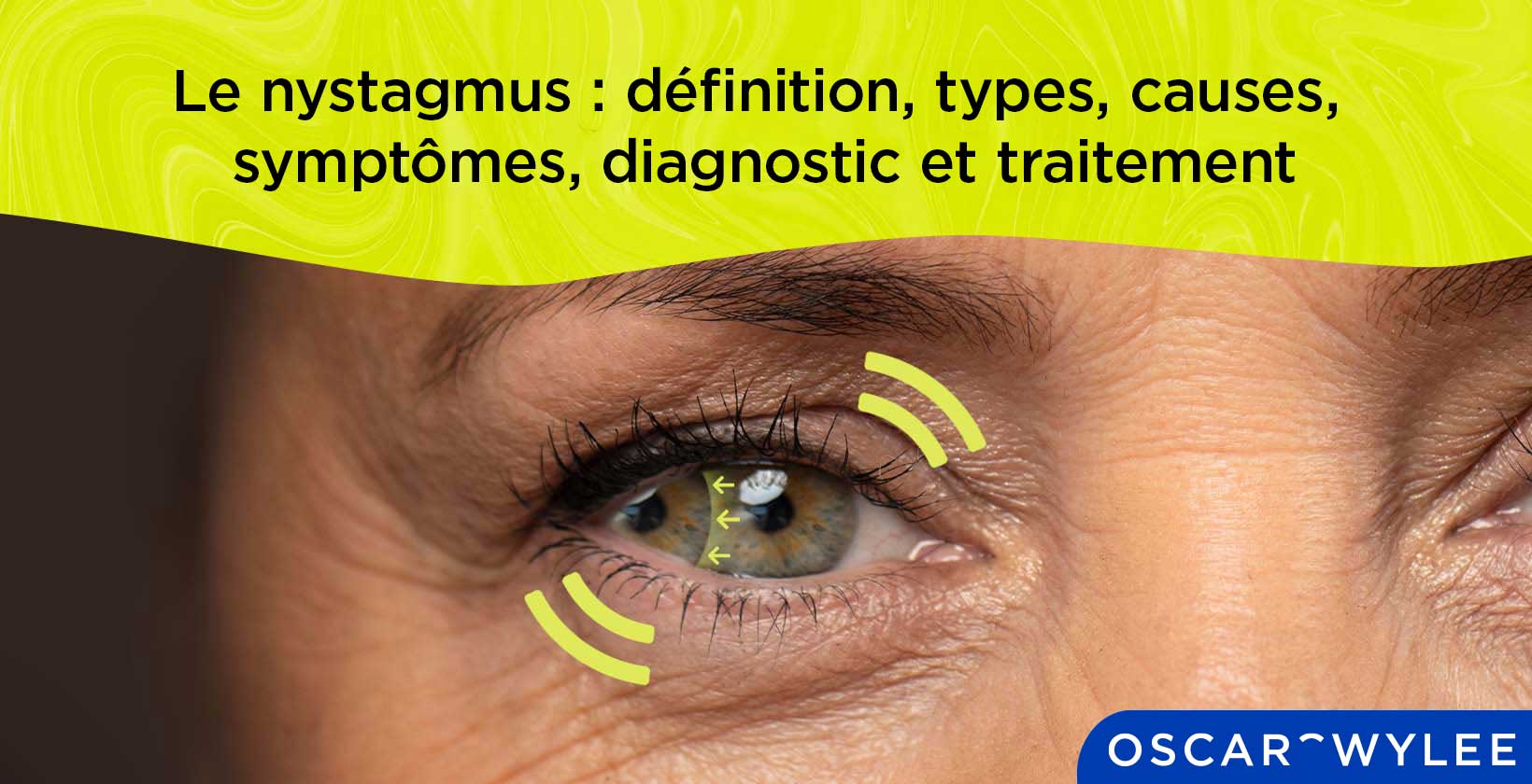 Le nystagmus : définition, types, causes, symptômes, diagnostic et traitement