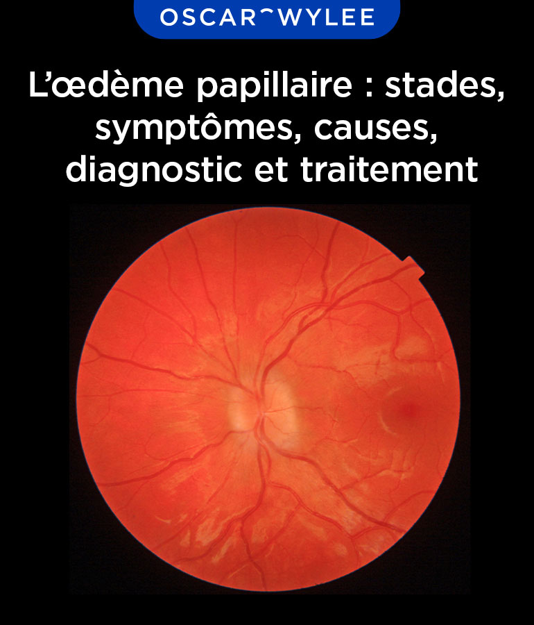 L'œdème papillaire