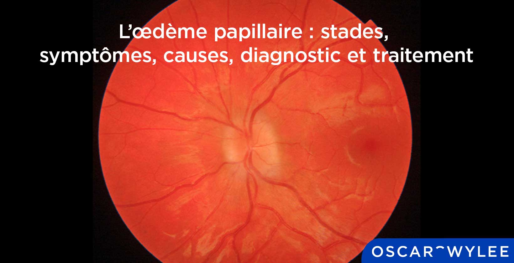 L'œdème papillaire