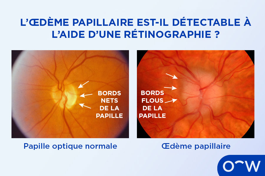 Une photographie d'une papille optique normale et une photographie d'une papille optique gonflée, montrant à quoi ressemble un œdème papillaire.