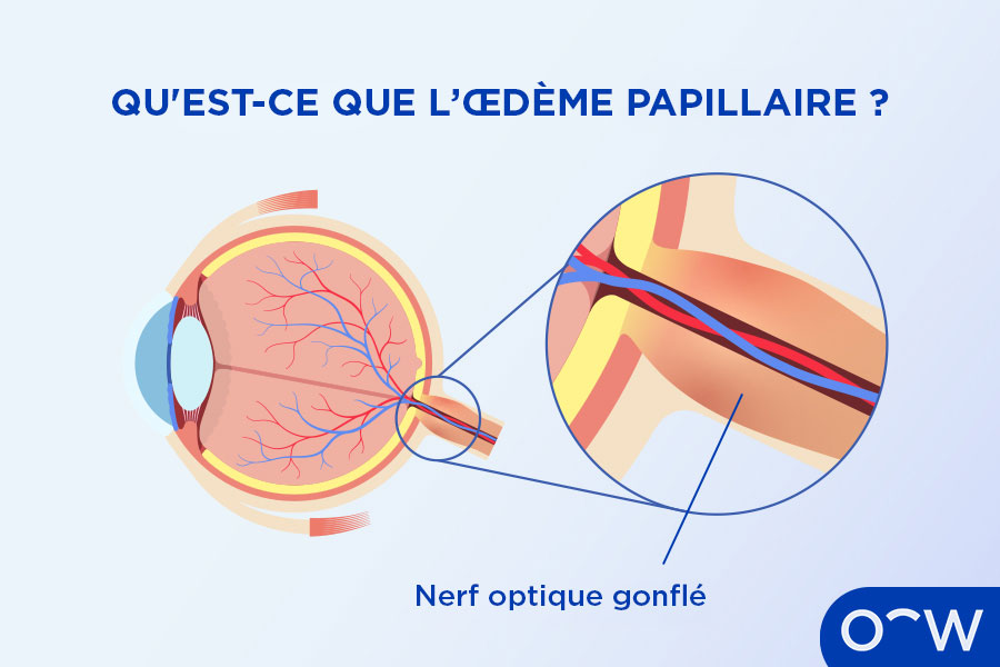 Une coupe transversale d'un œil et un gros plan du nerf optique, qui est gonflé, montrant l'œdème papillaire.