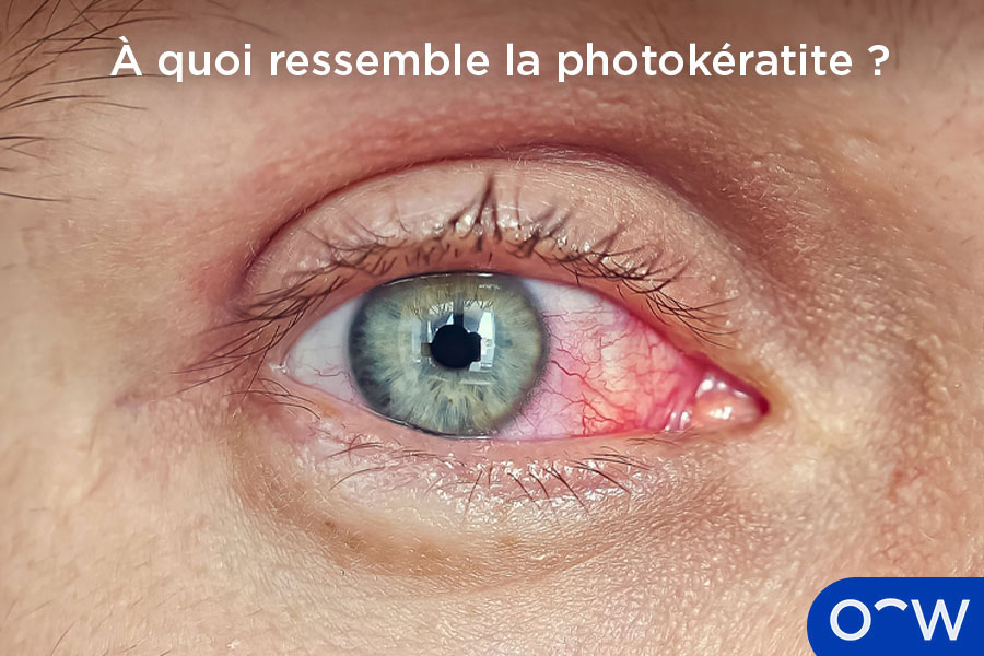 Des yeux touchés par la photokératite, montrant des signes de rougeur de la sclère.