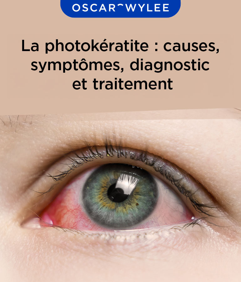 La photokératite