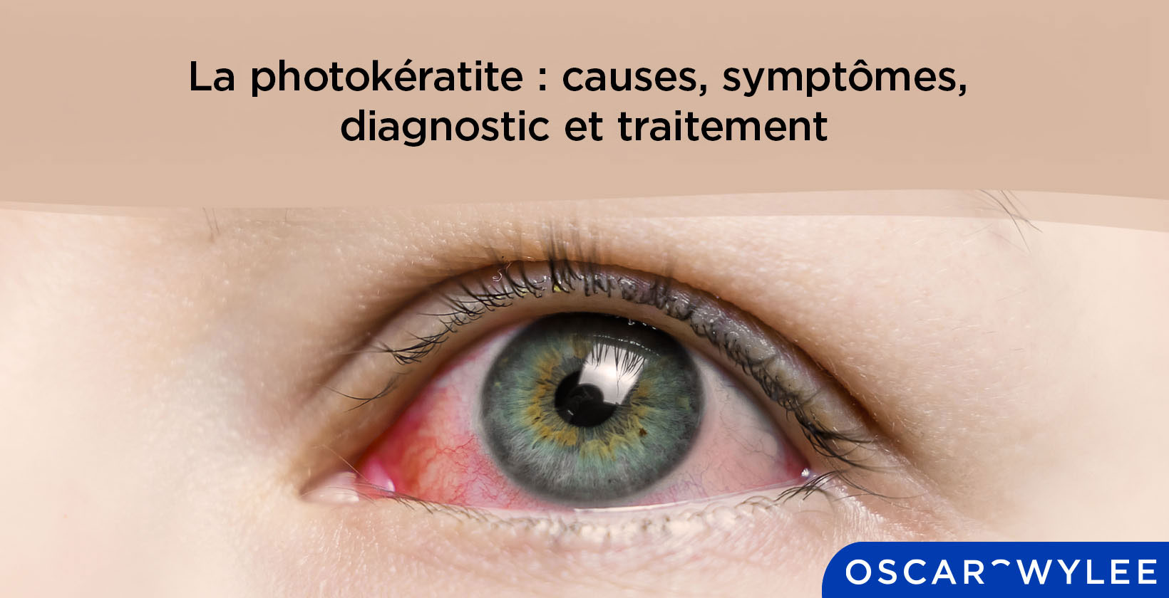 La photokératite