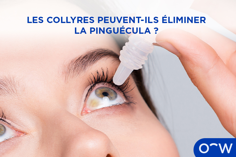Une personne appliquant un collyre dans son œil atteint de pinguécula.