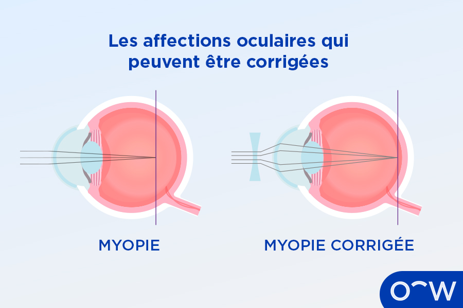 Illustration de la correction d'yeux myopes, qui change la manière dont la lumière est réfractée dans l'œil.