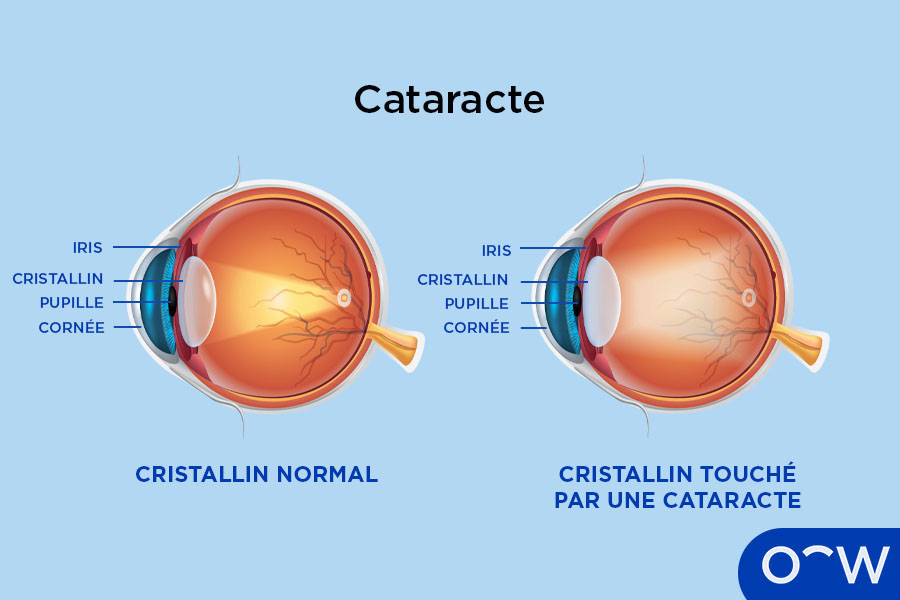 Un schéma montrant un cristallin normal et un cristallin touché
          par la cataracte