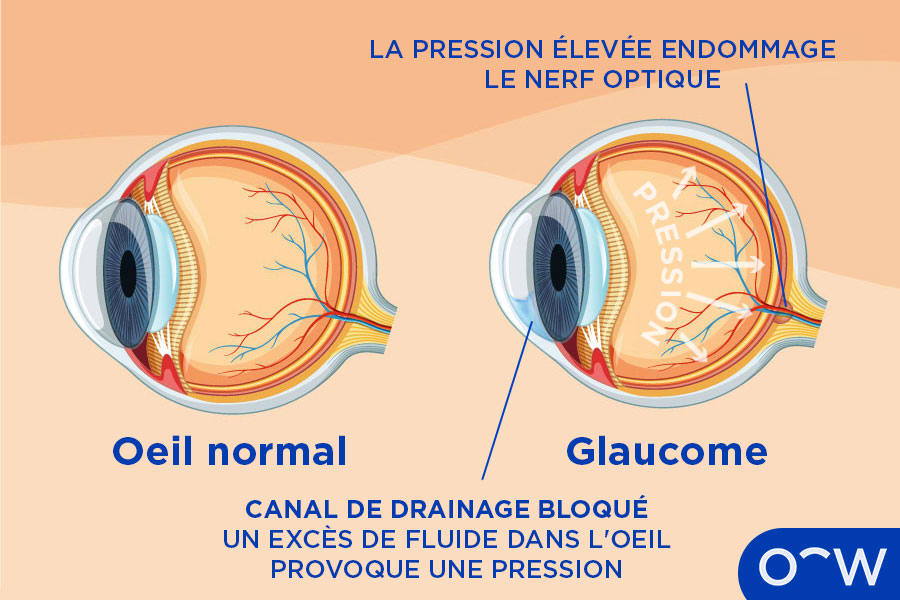 Un ophtalmologiste spécialiste du glaucome.