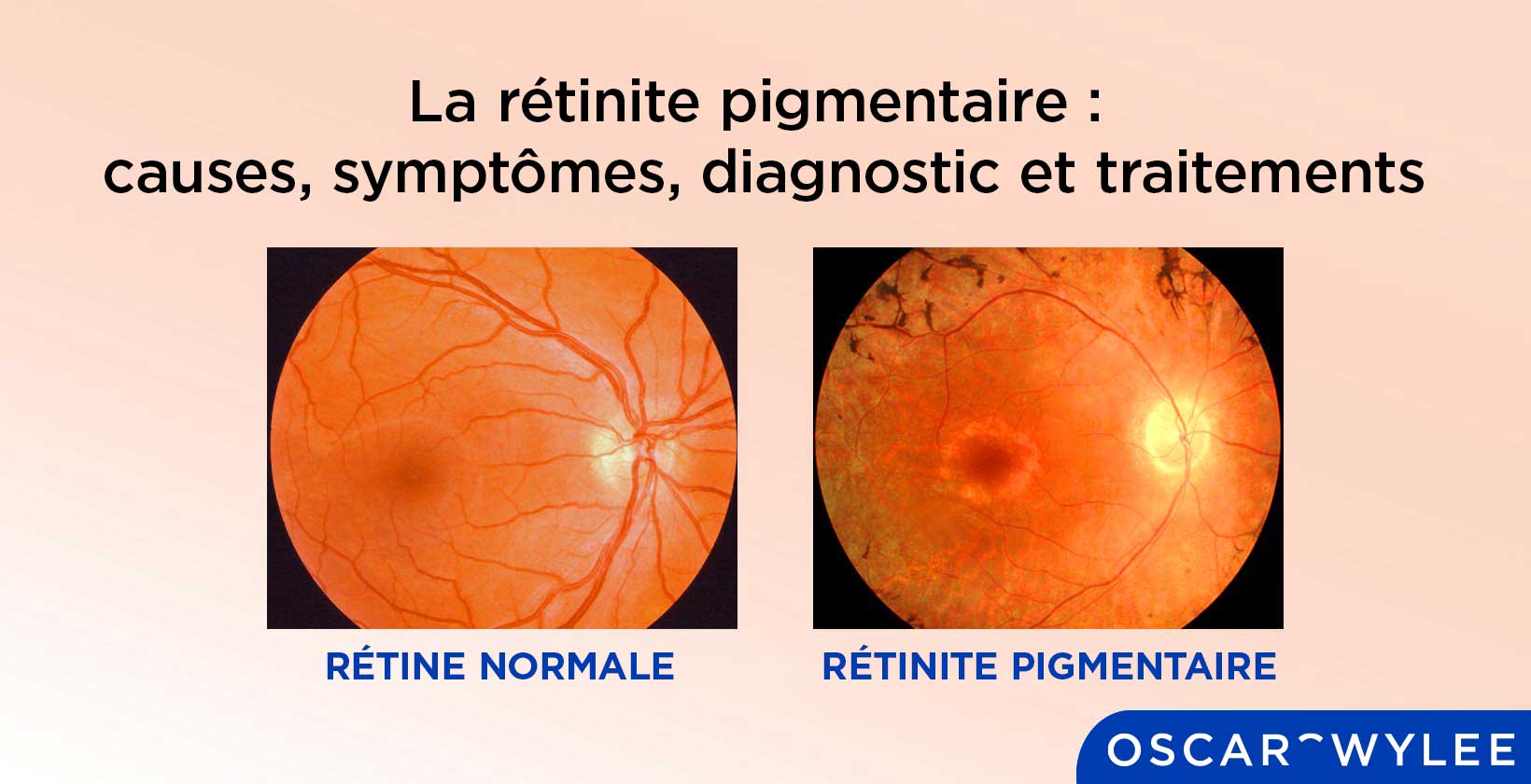 La rétinite pigmentaire.