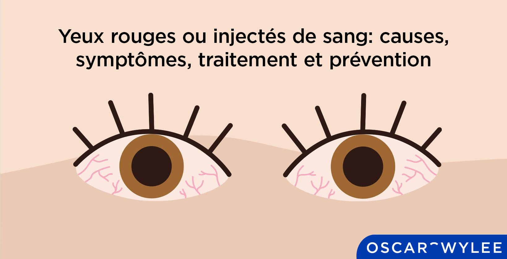 Les yeux rouges ou injectés de sang : causes, symptômes, traitement et
  prévention