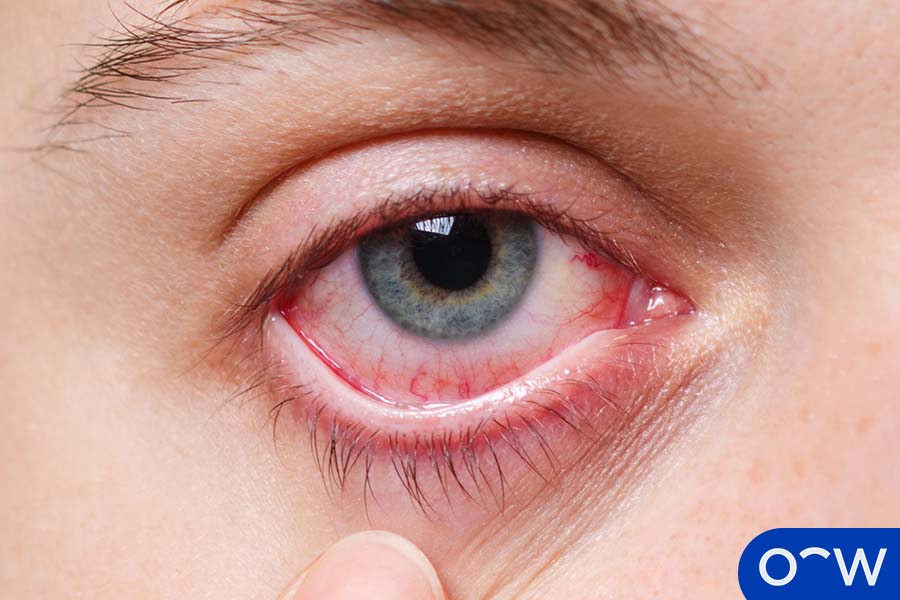 elfbar nachfüll pod läuft aus Yeux rouges et qui grattent : mon enfant souffre-t-il d'une allergie  oculaire ? – Optikids
