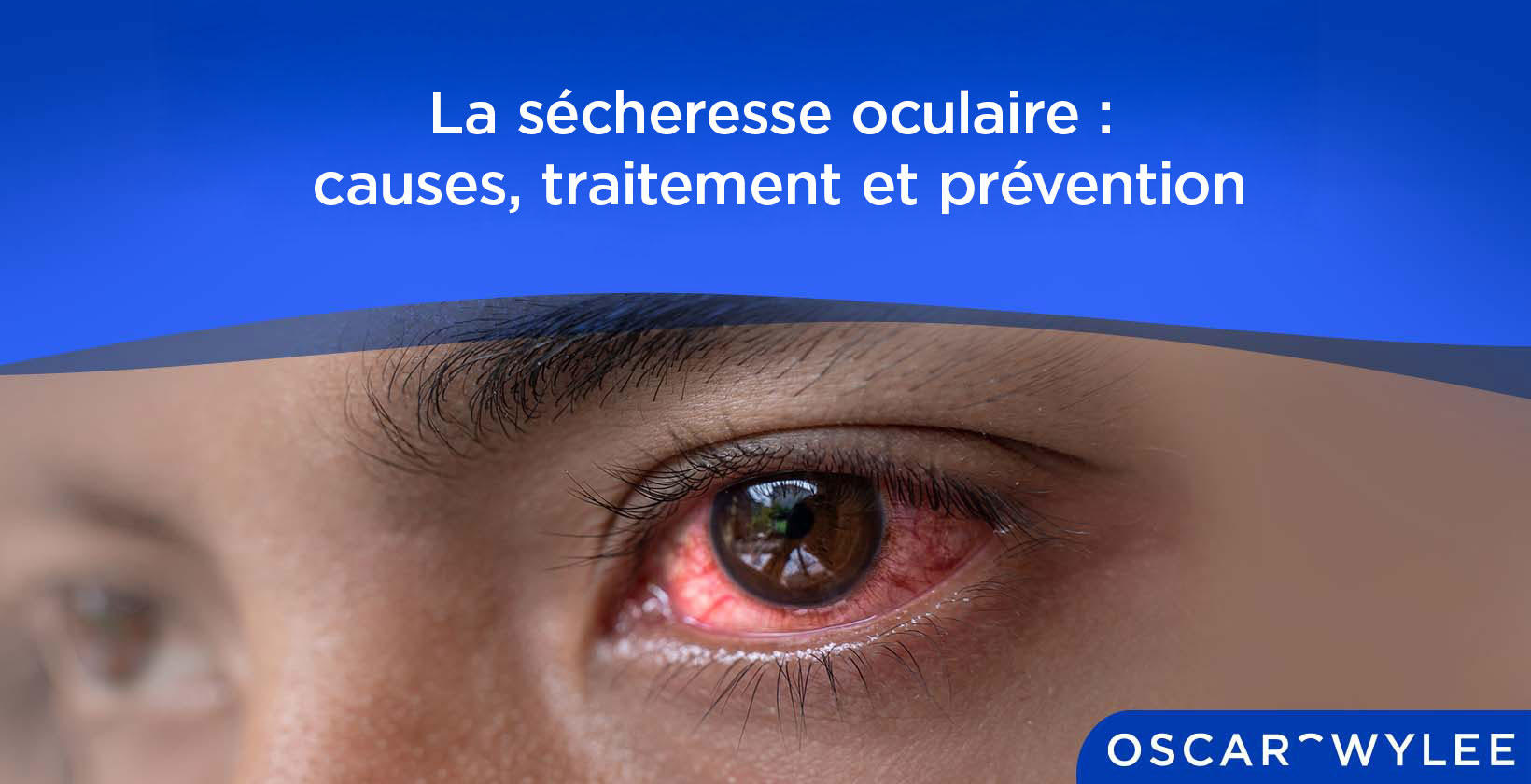 La sécheresse oculaire : causes, traitement et prévention
