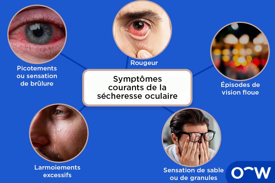 Un schéma illustrant les différents symptômes de la sécheresse oculaire.
